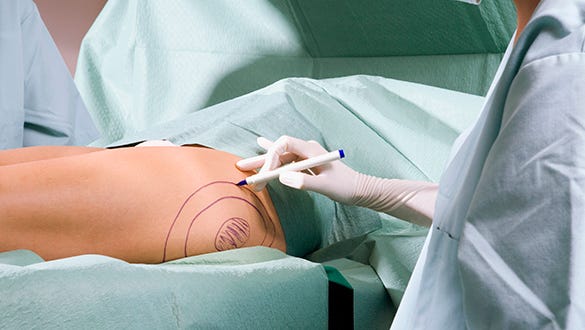 Picture of doctors drawing  circles on a leg as part of the Abdominoplasty surgery process