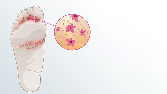 Graphic depiction of the excessive sweating disorder hyperhidrosis and its burst out its 