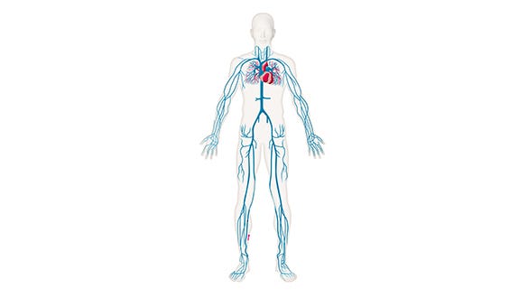 Pulmonary embolism