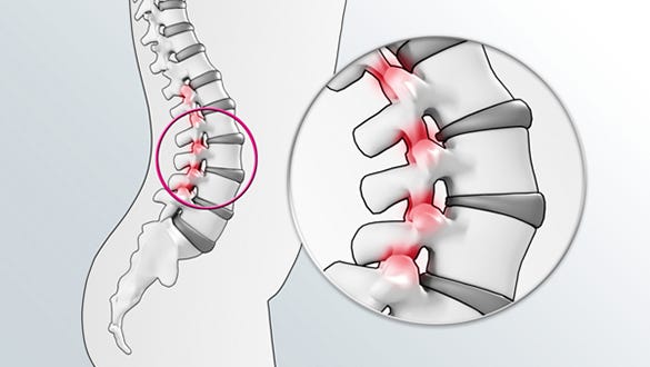 Facet joints – the joints between the vertebrae