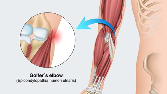 Graphic depiction of the anatomy change when having a Golfer's elbow