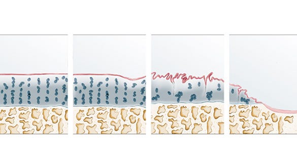 Graphic depiction showing the  different stages of osteoarthritis