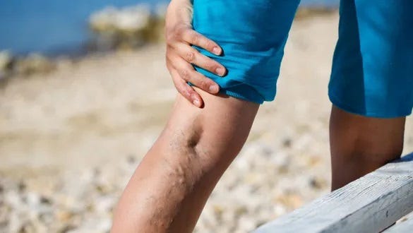 Image of male who is suffering from varicose veins on his calf 