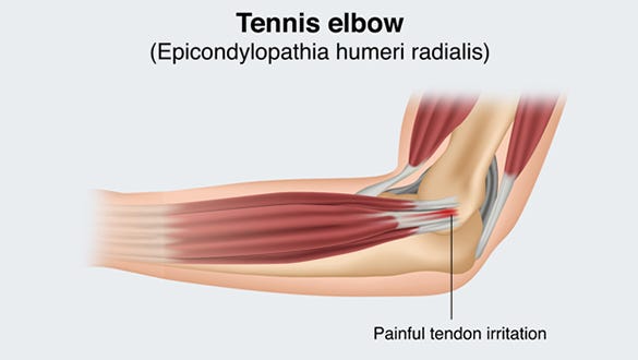 Graphic depcition of the anatomy change when havinf a Tennis elbow 