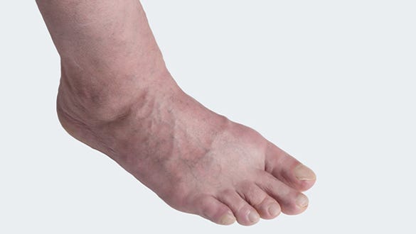 varicose vein disorder with swelling