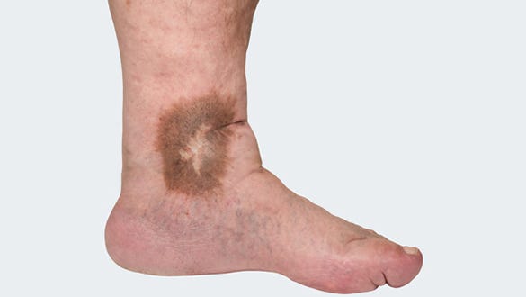 Varicose veins - Venous diseases - Compression - Indications