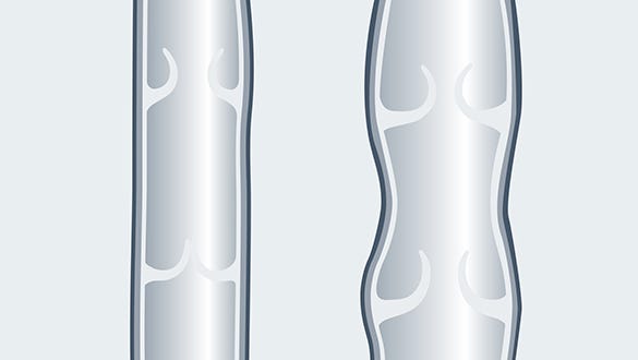 healthy vein and abnormal vein